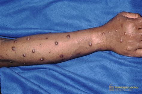 Multiple crusted hypopigmened nodules and plaques with rim of ...