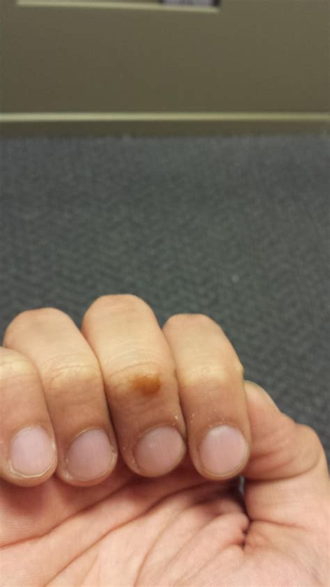 Brown spot appeared on top of finger over night. : r/medical