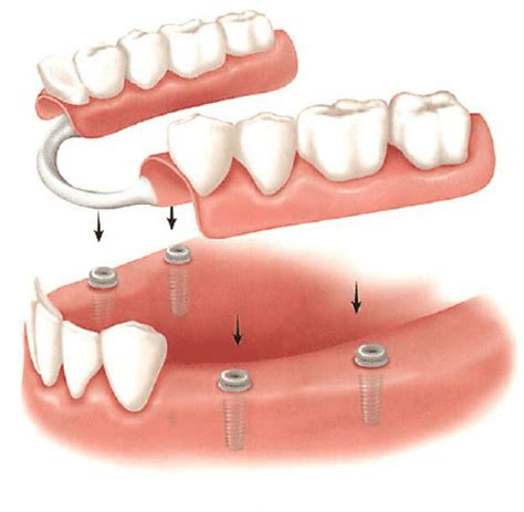 Mini Dental Implant Supported Denture 8 Images - Implant Supported ...