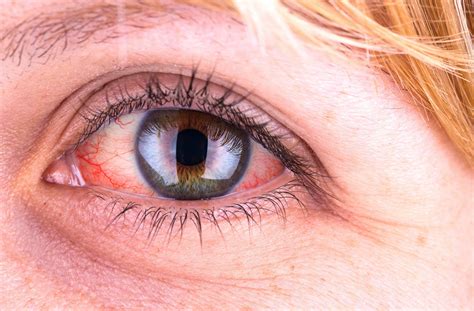 Uveitis: Causes, symptoms and treatment - IRIS