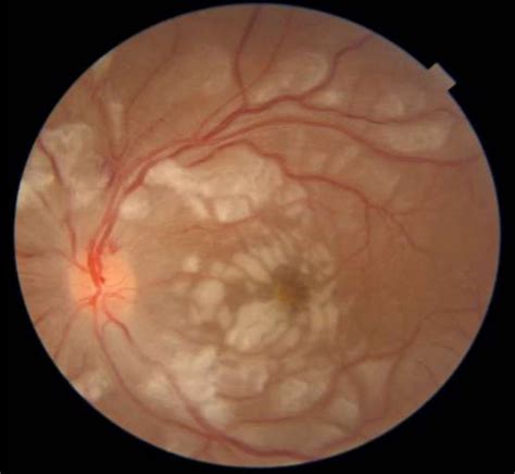 [Figure, Purtscher-like retinopathy in systemic lupus...] - StatPearls ...