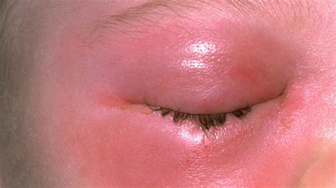 Periorbital Cellulitis: Causes, Symptoms, and Treatment