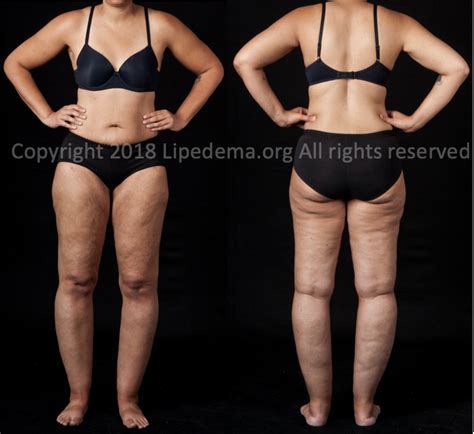 Staging of Lipedema — Lipedema Foundation