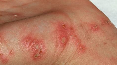 Scabies Photos - Scabies-Killer.Com