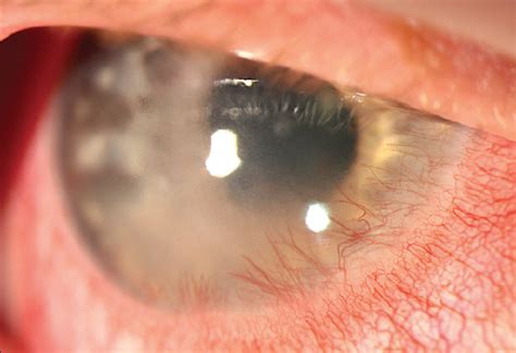 A Primer on Herpes Simplex Keratitis - Modern Optometry