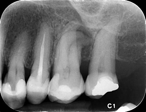 Chronic Apical Periodontitis - Kitsilano Endodontics