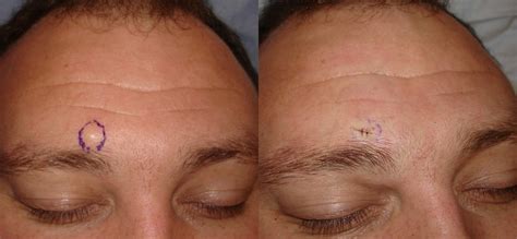 Sebaceous Cyst Face Removal