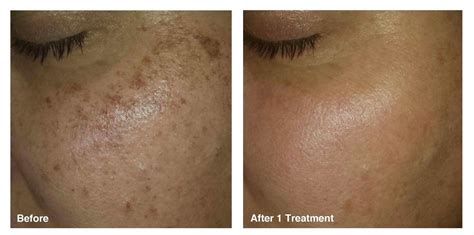 Laser Treatment For Dark Spots On Face Price