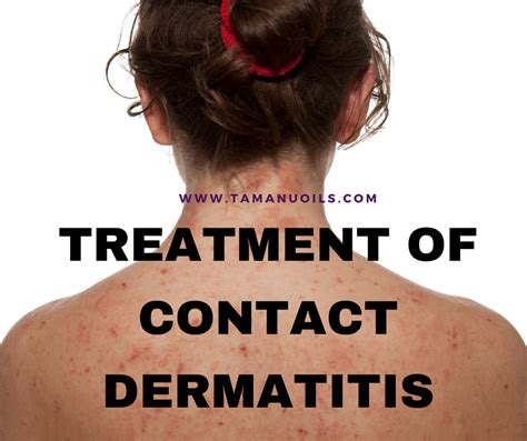 Treatment Of Contact Dermatitis - Tamanu Oils - Take care of yourself