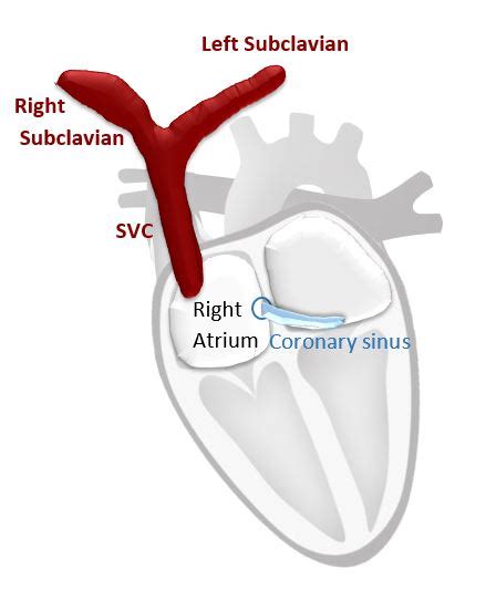 Persistent Left Superior Vena Cava (PLSVC): Anatomy and blood flow ...