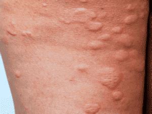 Hives (Urticaria) | Harley Street Dermatology Clinic