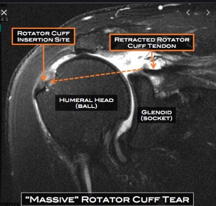 Orthopedic Surgeon Expert Witness: When an “abnormal” MRI of the ...