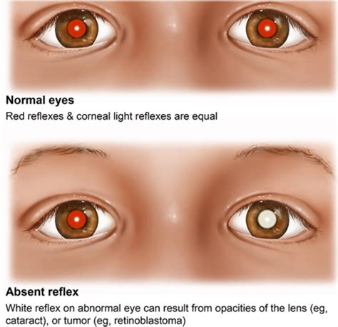 Corneal Light Reflex Abnormal Findings