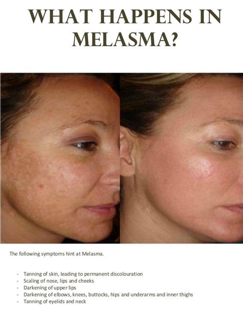 The way you designed Best treatment melasma face ~ Renewal Skin