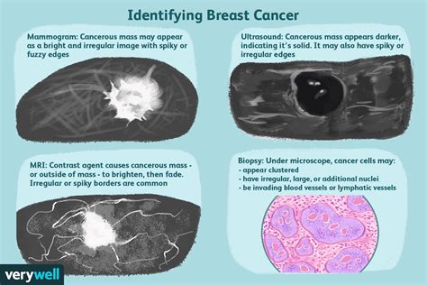 Breast Masses: Cancerous Tumor or Benign Lump?