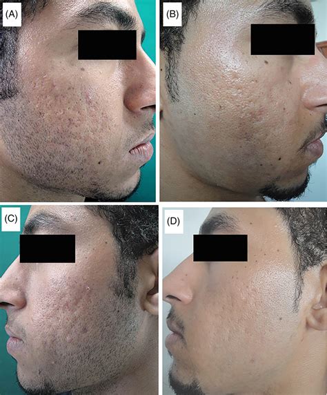 A male patient of group B, (A) Right side of the face with atrophic ...