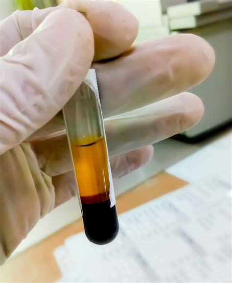 Paroxysmal Nocturnal Hemoglobinuria Overview