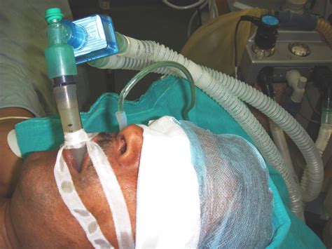 WILL YOU HAVE A BREATHING TUBE DURING YOUR SURGERY? - The anesthesia ...