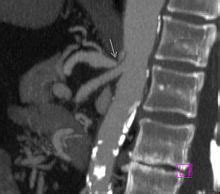 Median arcuate ligament syndrome | Celiac artery, Vascular ultrasound ...