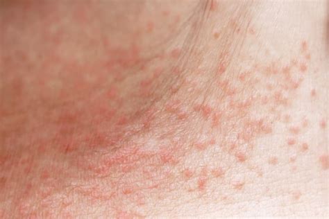 Heat Rash: Pictures, Symptoms, Causes, Types, and Treatment