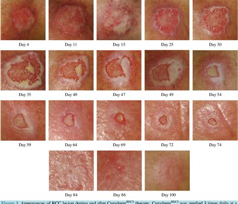 Basal Cell Skin Cancer Treatment