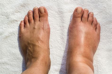 Gout Tophi: Signs, Development, and Treatment