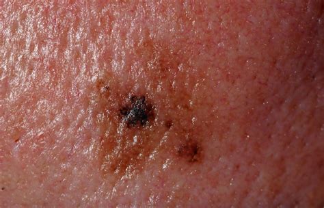 Melanoma in situ photos | Symptoms and pictures