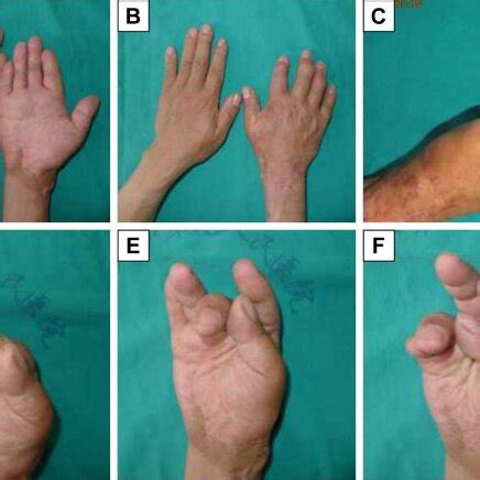 appearance and function after surgery. Notes: (A) palm side at 2 years ...