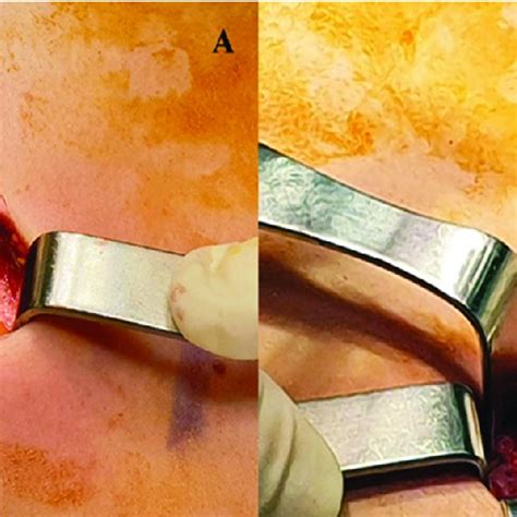 Anterior mediastinotomy (A) and sampling of mediastinal mass with ...