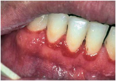 Linear Gingival Erythema