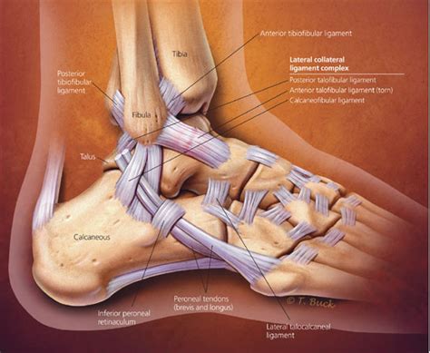 High Ankle Sprain vs. Ankle Sprain: What’s the Difference? | HSS (2022)