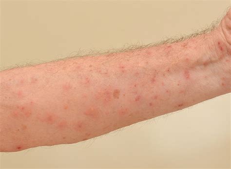 Scabies Outbreaks in Nursing Homes | Pintas & Mullins