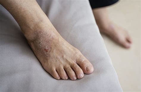 5 Reasons Why Your Feet Are Peeling - Feet First Clinic