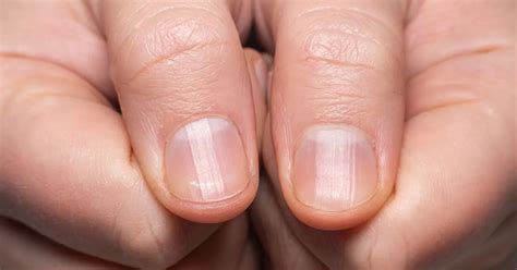 What ridges in your nails mean – and when it's time to call a doctor ...