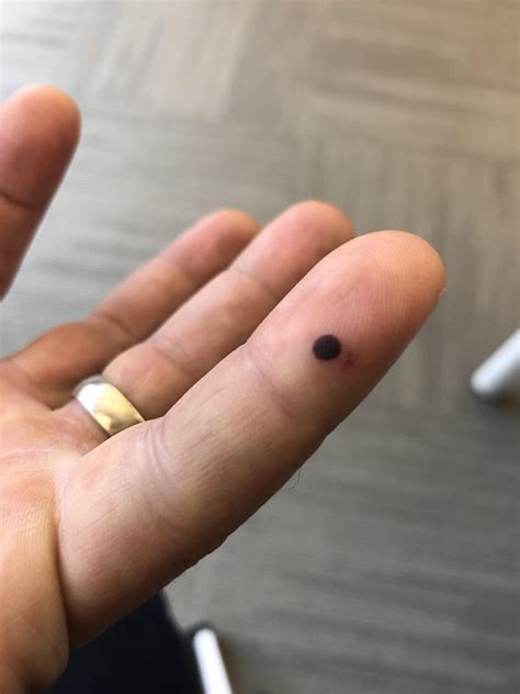 My perfectly round blood blister : r/mildlyinteresting