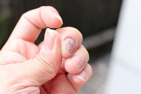 Infected cuticles: causes and the best treatment for cuticle damage