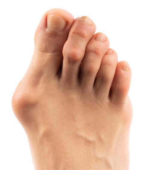 Bunions – Golden Triangle Foot & Ankle Specialists