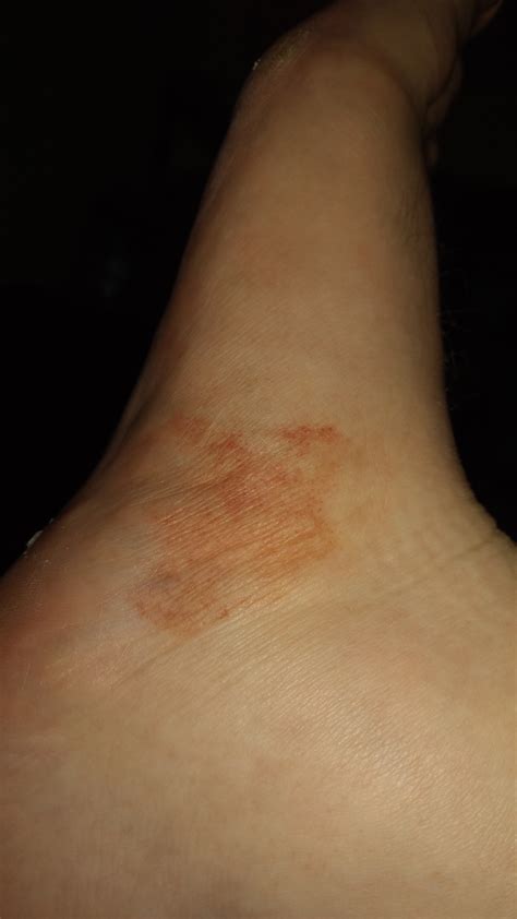 Foot Rash / Covid 19 Images Dermnet Nz - Chilblains and chilblain lupus ...