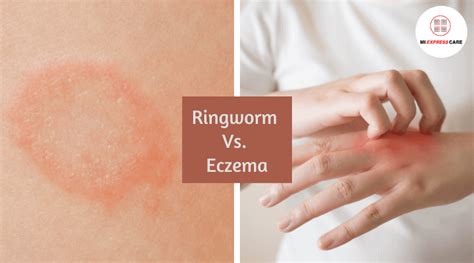 Nummular Eczema Vs Ringworm Symptoms Causes And Treatment | Images and ...