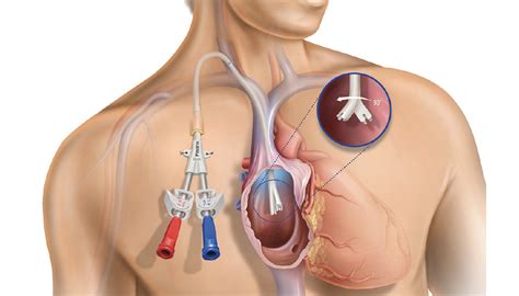 The Pristine™ Long-Term Hemodialysis Catheter: Physicians’ Perspectives ...