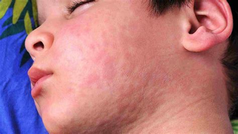 What Does Sun Allergy Rash Look Like? See These Pictures