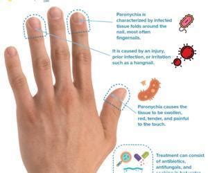 Acute Paronychia Treatment