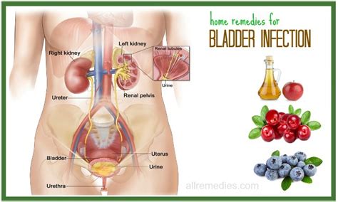 25 Natural Home Remedies for Bladder Infection Pain