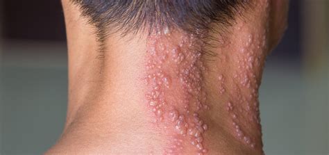 Shingles – Herpes Zoster | Dermatology and Skin Health - Dr. Mendese