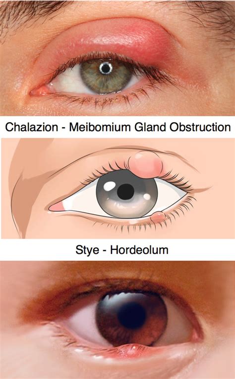 Eyelid Infections - Chalazion and Stye (Hordeolum)