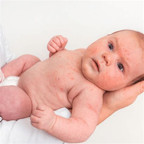 Infants with Eczema - Helping Them Sleep Better