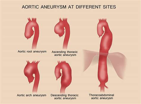 Aortic Aneurysm - Phoenix Cardiac Surgery