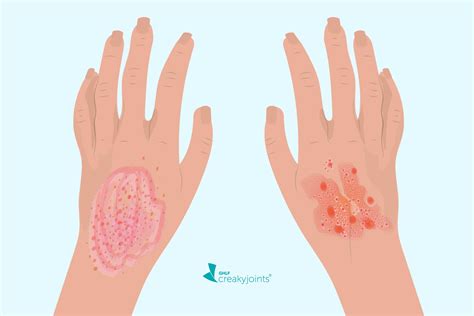 Eczema vs Psoriasis: What’s the Difference?