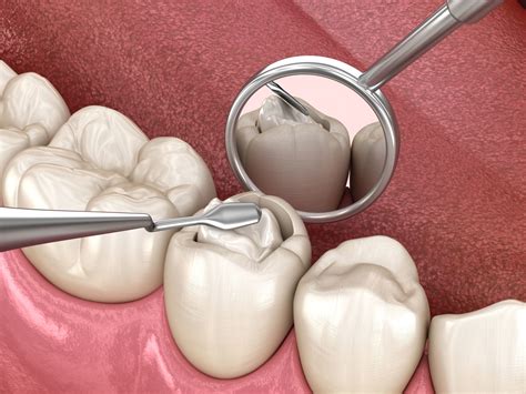 Sealing Vs. Filling Cavities: What's The Difference? | Acorn Dentistry ...