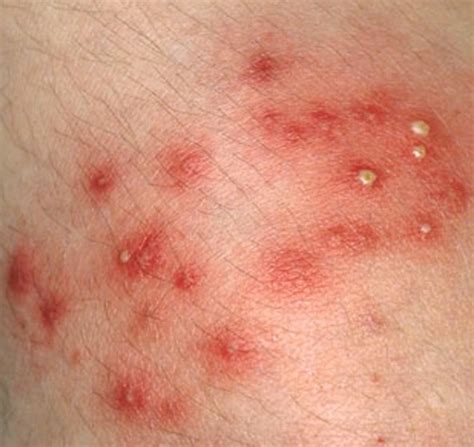 Staph Infection: Causes, Contagious, Symptoms, Treatment, and Pictures ...